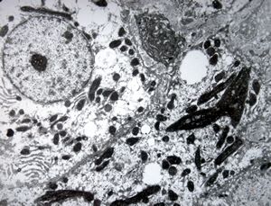 F,6y. | Wilson disease - megamitochondrion F,6y. | Wilson disease - megamitochondrion